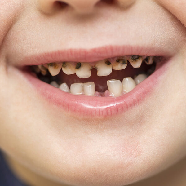 Why Are Baby Teeth Important? A Complete Guide for Parents