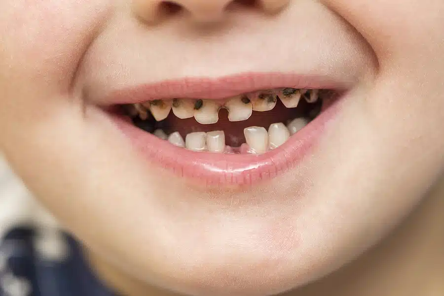 Why Are Baby Teeth Important? A Complete Guide for Parents