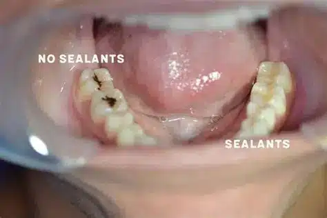 How Do Dental Sealants Work