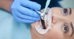 Why Get Sealants for Teeth