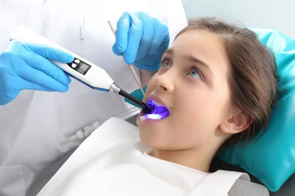 Dental sealant longevity