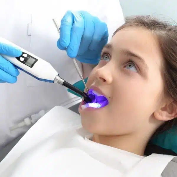 Dental sealant longevity