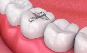 tooth filling material